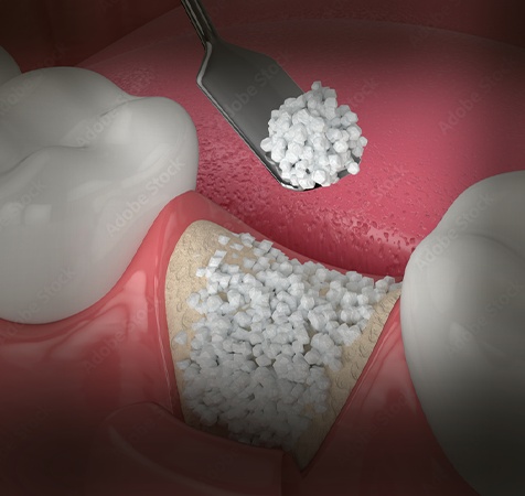 Bone Grafting