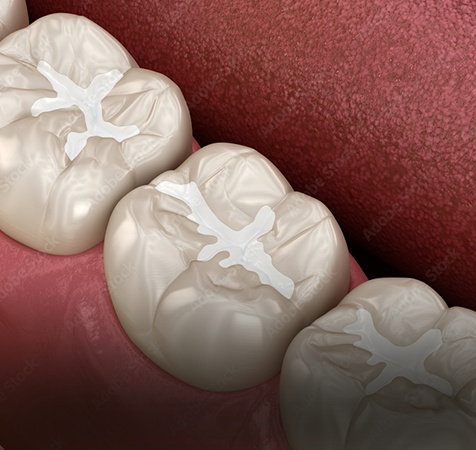 Fillings