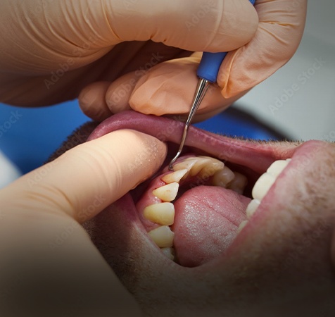 Periodontal Surgery