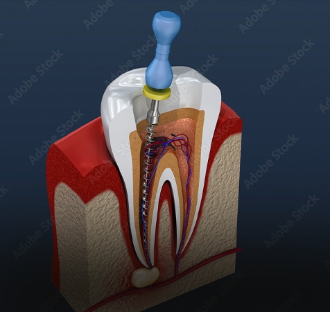 Root Canals