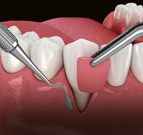 Soft Tissue Grafts