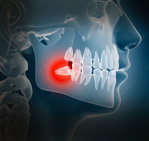 Wisdom Teeth